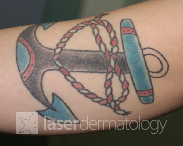 Laser Dermatology | Tattoo Removal